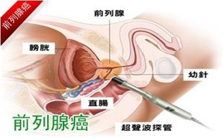 前列腺喝咖啡_前列腺喝咖啡_咖啡对前列腺什么作用